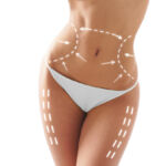 Female body with the drawing arrows on it isolated on white. Fat lose, liposuction and cellulite removal concept.ridebukselår